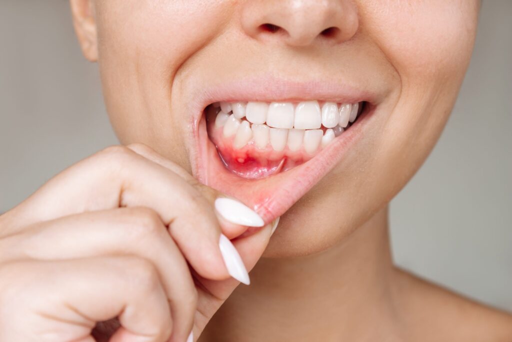 Understanding Gum Disease: Symptoms, Causes, and Treatment