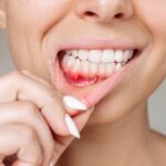 Understanding Gum Disease: Symptoms, Causes, and Treatment